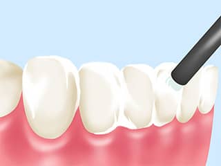 歯のフッ素塗布