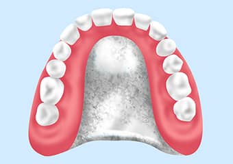 総入れ歯