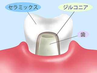 ジルコニア