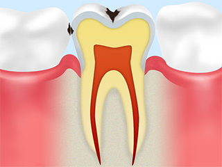 エナメル質の虫歯【C1】