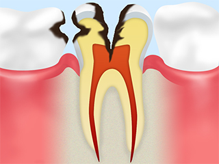 神経にまで達した虫歯【C3】