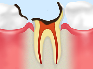歯根にまで達した虫歯【C4】